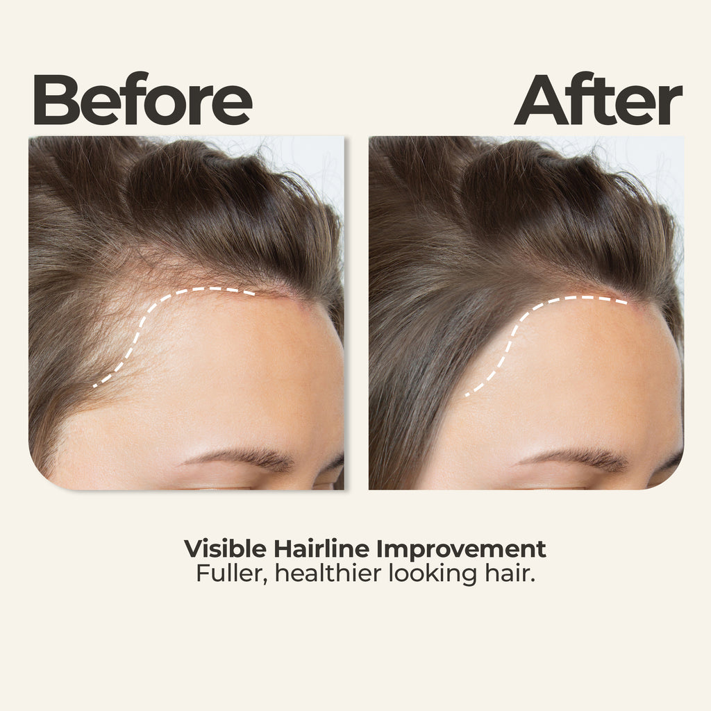 Rosemary Oil + Head Massager (Bundle)
